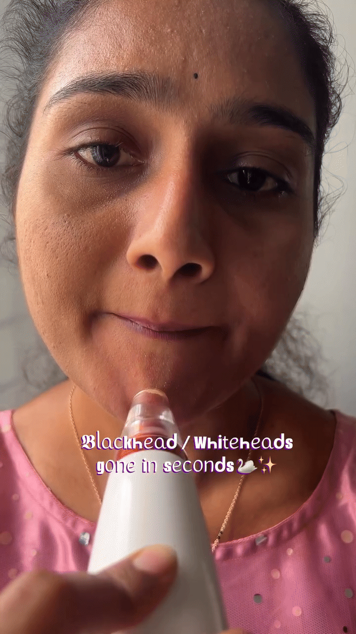 "ShineSkin™ Portable Blackhead Remover"