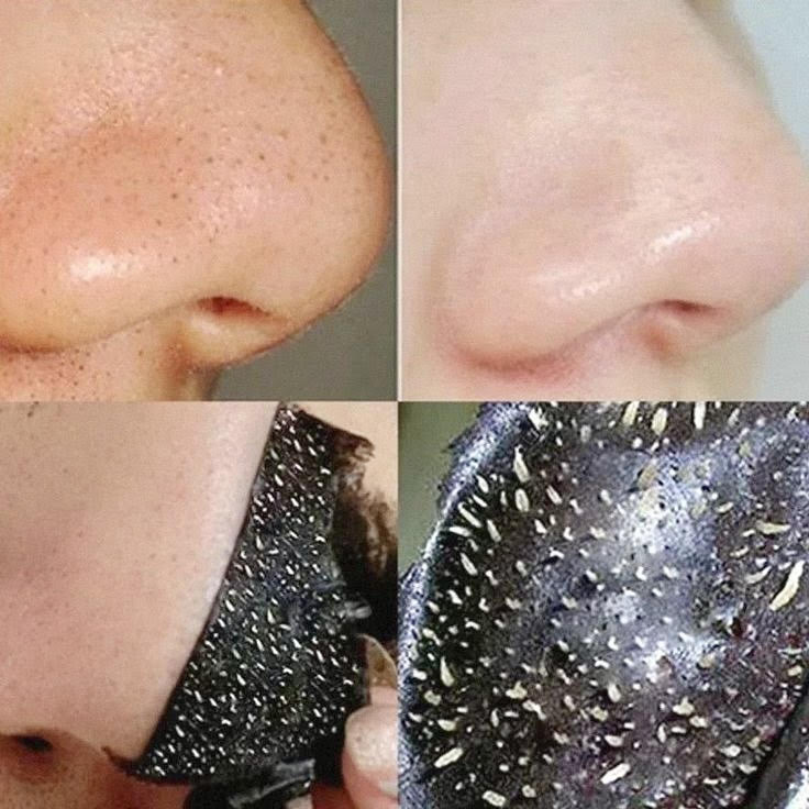 "ShineSkin™ Portable Blackhead Remover"