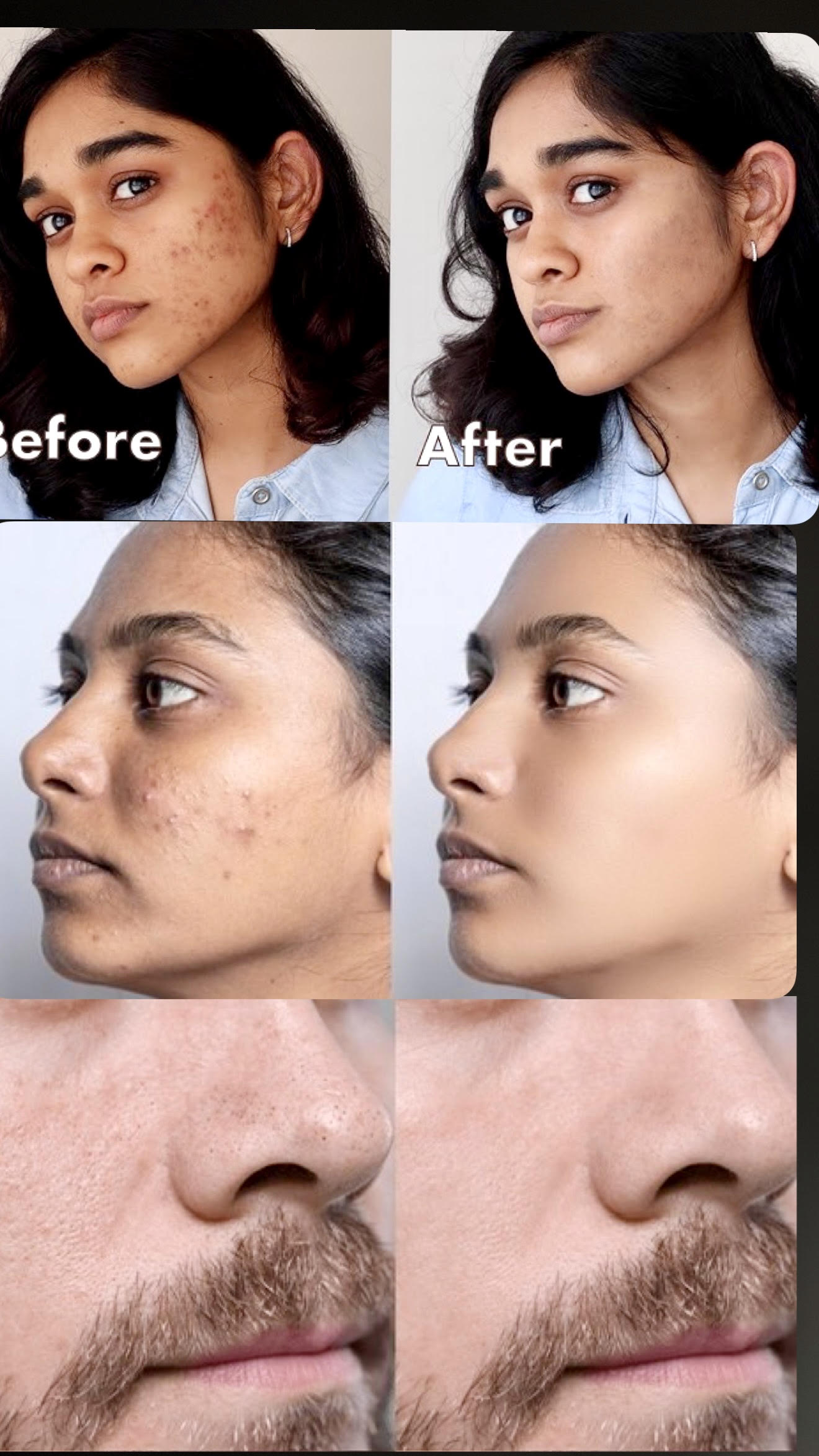 "ShineSkin™ Portable Blackhead Remover"